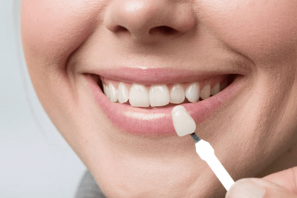 dental veneers