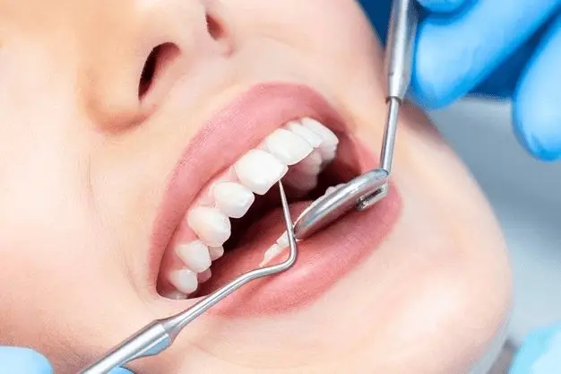 dental fillings in Clermont