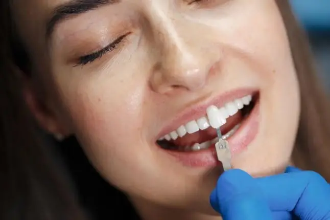 dental veneers